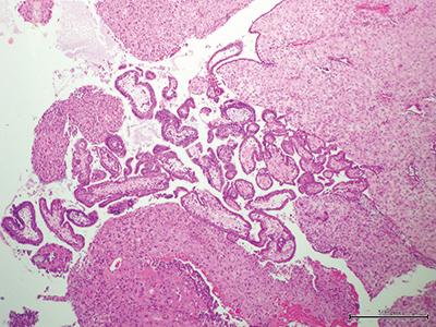 Fig. 3. Retained placental material. Decidualized endometrium surrounds placental villi, consistent with retained placental materials. (10×, hematoxylin-eosin stained.)