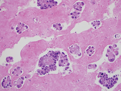 Fig. 5. Cell block technique for cell pellet or tissue fragments—method No. 2 using saline, RPMI, or formalin for collection, hematoxylin and eosin stain, 20×.