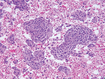 Fig. 1. Plasma thrombin cell block preparation, hematoxylin and eosin stain, 20×.
