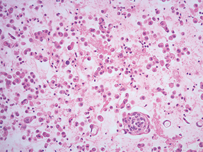 Fig 2. Collodion bag cell block procedure, hematoxylin and eosin stain, 20×.