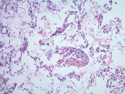 Fig. 3. Collodion bag cell block procedure, hematoxylin and eosin stain, 20×.