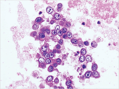 Fig. 4. Cellient automated cell block system preparation (ascitic fluid preparation, adenocarcinoma, hematoxylin and eosin stain, 40×).