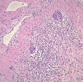 Fig. 2. Tumor demonstrating lymphatic vessel invasion.
