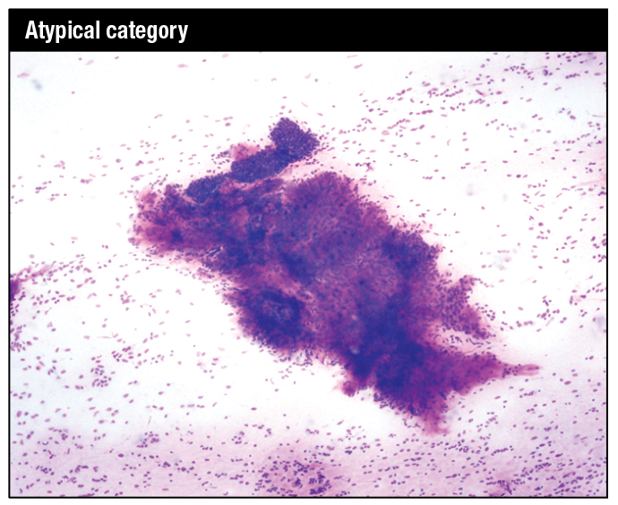 Modified Giemsa stain. Moderately cellular smear showing a large mildly hypercellular stromal fragment containing a branching capillary and with an adjacent tissue fragment of ductal epithelial cells in a background of stripped nuclei, raising the possibility of a low-grade phyllodes tumor.
