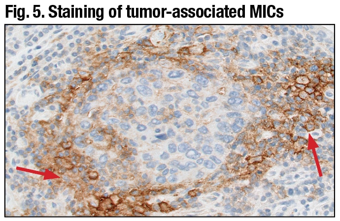 PD-L1 primary antibody exhibiting linear membrane and/or cytoplasmic staining of tumor-associated mononuclear inflammatory cells (arrows) (20× mag­nification).