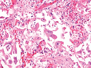 Figure 4.28. Diffuse alveolar damage in a lung demonstrates many reactive-appearing cells with overall enlargement and large nucleoli. Many of these cells were positive for cytomegalovirus IHC (H&E, 400X). 
