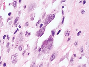 Figure 4.30. Characteristic nuclear Cowdry type A and cytoplasmic inclusions within endothelial cells in this case of myocarditis (H&E, 1000X).