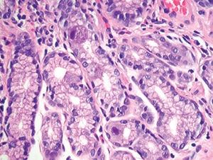 Figure 4.31. Intestinal biopsy shows two epithelial cells with clear cytomegalovirus viral cytopathic effect. Note the lack of associated inflammation (H&E, 200X). 