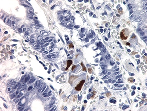 Figure 4.32. Multiple epithelial cells stained positively with cytomegalovirus IHC in a patient with severe gastroenteritis. Endothelial cells (not shown) were also highlighted (400X).