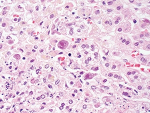 Figure 4.33. Cytomegalovirus adrenitis in a patient with AIDS, showing enlarged cells with intranuclear and cytoplasmic inclusions (H&E, 200X).