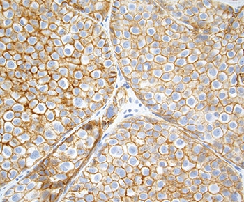 Fig. 12: PLCIS with aberrant E-cadherin expression