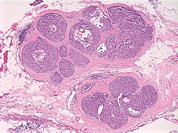 Fig. 4: Pleomorphic LCIS