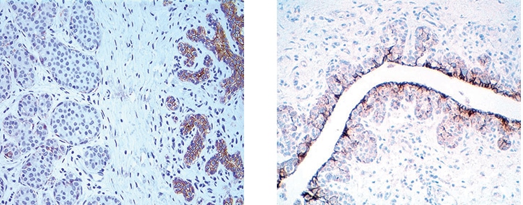Fig. 8: LCIS: Loss of E-cadherin expression
