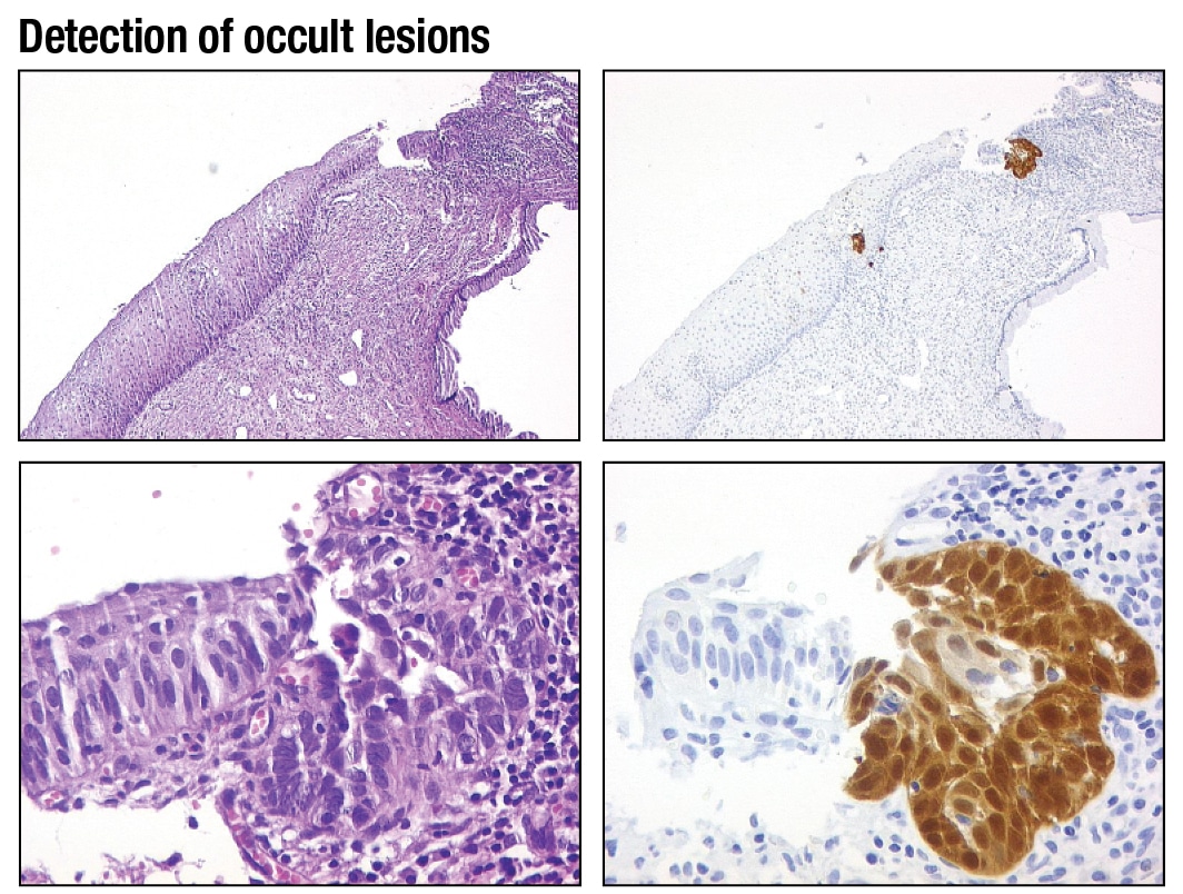 This biopsy was reviewed by three gynecological pathologists and none made a diagnosis of CIN 2, 3. However, p16 staining highlighted a small area of p16 positivity that on high magnification shows considerable atypia. The final diagnosis was CIN 2, 3.