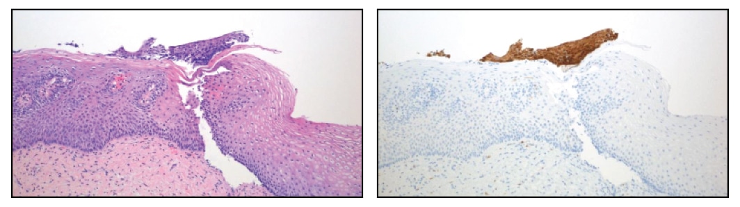 This biopsy has a small detached fragment of atypical squamous epithelium that was either originally overlooked or considered too small to be diagnostic for CIN 2, 3. After p16 staining the case was reclassified to CIN 2, 3 because the detached atypical fragment has strong, diffuse block staining.
