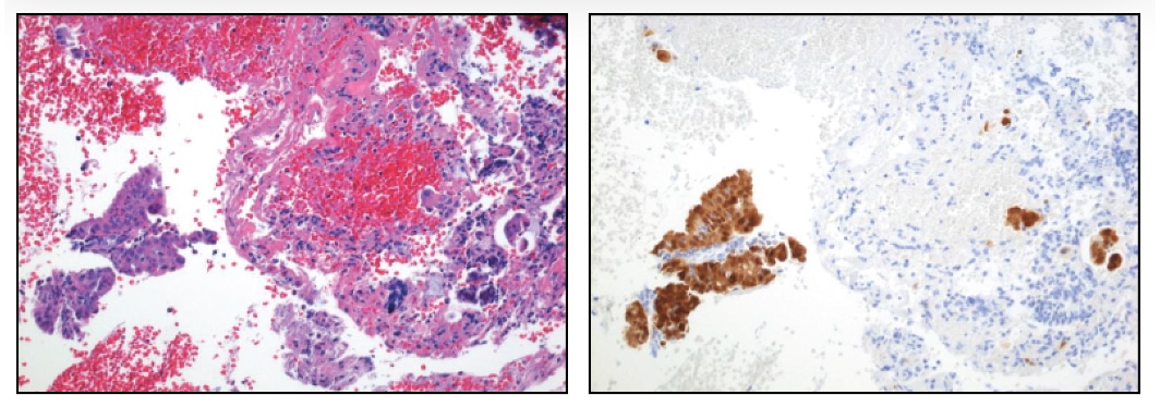 Endocervical curettages not infrequently contain small clusters of atypical squamous cells that are difficult to classify. This case was originally classified as normal, but because the clusters were strongly positive for p16, the case was reclassified as CIN 2, 3.