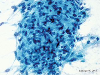 Non-neoplastic. This aspirate of granulomatous sialadenitis shows a large group of epithelioid histiocytes; an infectious agent should be excluded (smear, Papanicolaou stain).