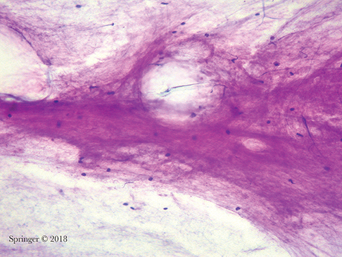 Atypia of undetermined significance. This aspirate contains abundant mucin without any epithelial cells. The differential diagnosis includes a benign mucinous cyst; however, a low-grade mucoepidermoid carcinoma cannot be excluded (smear, Romanowsky stain).