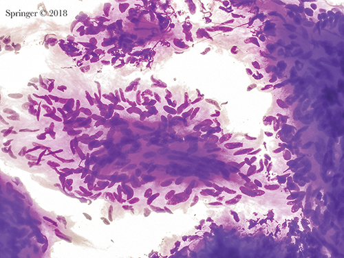 Neoplasm: benign. This aspirate of schwannoma shows a group of bland spindle cells with wispy cytoplasm. The cytoplasmic borders are indistinct. Nuclei are spindle-shaped and display bends or curves (smear, Romanowsky stain).