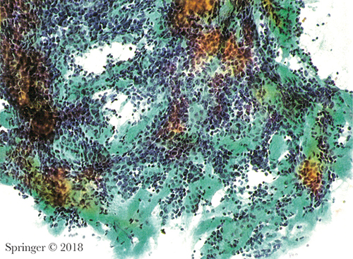 Suspicious for malignancy. This smear is composed of basaloid cells and abundant matrix spheres with a pattern suspicious for adenoid cystic carcinoma (smear, Papanicolaou stain).
