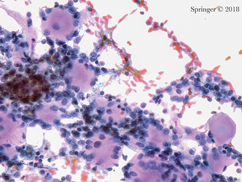 Malignant. Adenoid cystic carcinoma. Aspirates show small high N:C ratio basaloid tumor cells surrounding acellular matrix with a cribriform pattern (smear, Papanicolaou stain).