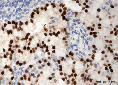 Acinic cell carcinoma. SOX10 immunostain showing strong nuclear expression in the tumor cells in a cell block.