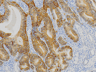 Fig.3 Gastric cancer with HER2 amplification/overexpression frequently exhibits basolateral or lateral reactivity with IHC (shown above); this is in contrast to HER2 amplified breast cancer which exhibits complete membranous reactivity.