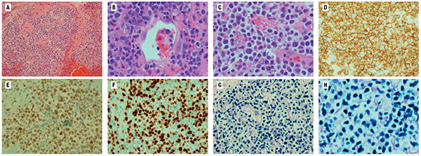 Fig. 2. Histology showing primary CNS diffuse large B-cell lymphoma, PTLD. A) Low-power H&E showing brain tissue with large lymphoid cell infiltrate. B) Perivascular lymphoid infiltrate. C) 20× H&E showing large diffuse lymphoid cells. D) Immunohistochemical stain showing large lymphoid cells are CD20+. E) Immunohistochemical stain showing large lymphoid cells are BCL2+. F) Ki-67 showing proliferation index of 50 to 60 percent. G) Low-power view of EBER-ISH showing positive large cells. H) High-power view of EBER-ISH showing nuclear staining of EBV+ cells.
