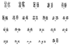 Fig. A. Conventional cytogenetic studies show a complex karyotype: 47,XX,der(9)t(9;22)(q34;q11.2), ider(22)(q10)t(9;22),+ider(22)(q10)t(9;22)[3]/46,XX[17].