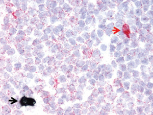 RNAscope Ig kappa (black) and lambda (red) mRNA in lambda-restricted B-cell lymphoma