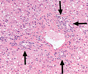 Fig. 3.1.2. Bile duct proliferation. This donor liver biopsy demonstrates several bile duct profiles (arrows) with only one hepatic arteriole. This finding is not a contraindication to using this liver for transplantation. 