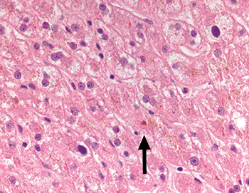 Fig. 3.1.3. Cholestasis. Mild hepatocellular and/or canalicular cholestasis may be seen in a cadaveric donor liver. These changes may be related to circumstances around the donor’s demise and are not a contraindication to transplantation. 