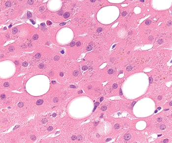 Fig. 3.1.4. Macrovesicular steatosis. In macrovesicular steatosis, one or a few round fat droplets displace the hepatocyte nucleus to the edge of the cell. 