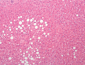 Fig. 3.1.5. Mild macrovesicular steatosis (<30%; frozen section). Cadaveric livers with mild steatosis are widely considered suitable for transplantation. 