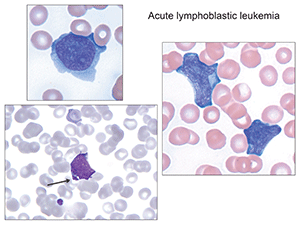 Fig.2. Arrowed image identifies azurophilic granules which can sometimes be seen, so-called granular acute lymphoblastic leukemia. (Images in Figs. 2–6 from Atlas of Peripheral Blood: The Primary Diagnostic Tool. Pereira I, George TI, Arber DA. Philadelphia: Wolters Kluwer/Lippincott Williams & Wilkins; 2012.)