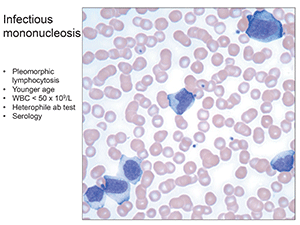 Fig.4. Infectious mononucleosis: Pleomorphic lymphocytosis, younger age, WBC < 50 x 109/L, heterophile ab test, serology.