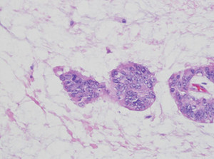 Fig. 2: High-power view of malignant cells in pools of mucin.
