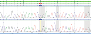 Fig. 2: Chromatogram of Sanger sequencing confirming the findings by next-generation sequencing.