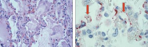 Hantavirus pulmonary syndrome. Photomicrographs of lungs: Pulmonary edema (left) and viral proteins (right). Courtesy Sherif Zaki, MD, PhD.