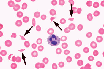 Figure 14-1. Representative blood smear showing schistocytes (arrows). From Glassy E, ed. Color Atlas of Hematology: An Illustrated Guide Based on Proficiency Testing. © 1998 College of American Pathologists.
