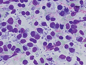 Fig. 1. Fine needle aspiration air-dried smear of right inguinal mass, showing dispersed monomorphous cells with scant cytoplasm, round nuclei with condensed chromatin, and inconspicuous nucleoli, consistent with small round blue cell tumor. Quik-Dip stain from Mercedes Medical, 1000× original magnification.