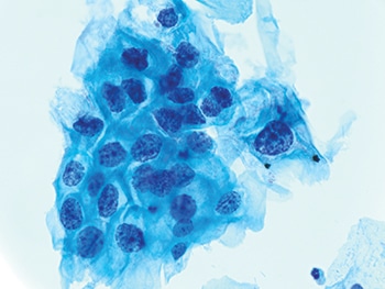 Fig. 2. One cluster of LSIL cells (600×) with nuclear enlargement and hyperchromasia. HPV-related cytoplasmic changes are not required for LSIL.