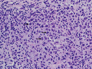 Fig. 1. Right neck mass needle core biopsy showing intermediate to large cells with anaplastic morphology, including hallmark cells (black arrows). H&E staining at 500× magnification.