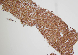 Fig. 2. The neoplastic cells expressed diffuse CD30 staining. 100× magnification.