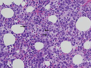 Fig. 3. The bone marrow core biopsy showing the diffuse involvement by the large neoplastic cells with increased mitotic activity and hallmark cells (black arrows). H&E staining at 500× magnification.