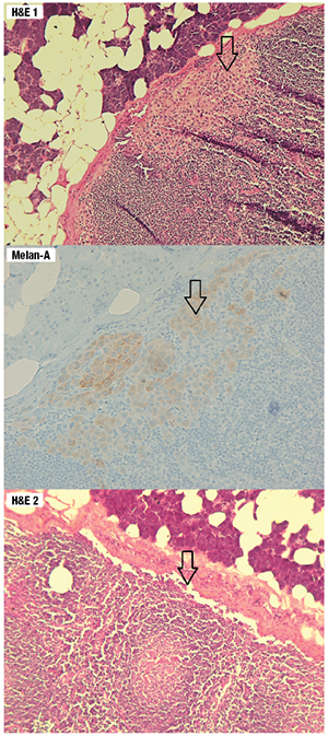 Fig. 1. The top and middle graphics reveal a focus of micrometastasis that is positive for Melan-A. The bottom graphic is the final H&E cut from the same tissue block which shows absence of the micrometastasis, demonstrating paucity of the tumor load. 