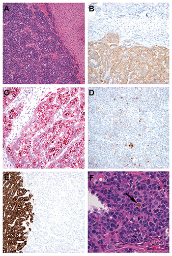 A. The intrahepatic tumor (left) was composed of monotonous small epithelioid cells arranged as nests and sheets with an “organoid” appearance. Background hepatic parenchyma is seen on the right (H&E×10).  B. Uniform synaptophysin uptake (lower half) was present within tumor cells (synaptophysin immunoperoxidase ×20). C. Detection of albumin mRNA by branch chain in situ hybridization showed uniform positivity within tumor cells with areas of hyperintense uptake (albumin branch chain ISH alkaline phosphatase ×20). D. Arginase was present with varying intensity in scattered tumor cells (arginase immunoperoxidase ×20). E. HepPar-1 expression was uniformly absent in tumor cells. Normal liver uptake is seen on the left (HepPar-1 immunoperoxidase ×20). F. A single bile plug (arrow) was detected within the tumor (H&E×40).