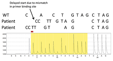 Fig. 6. The S602T alteration was under the pyrosequencing primer sequence. This may have caused the primer to bind inefficiently. A delayed start to elongation may account for the second C peak (position 5 in the strip). Thus, the first C may or may not have been incorporated. If it was not incorporated, then the second C might have been incorporated and this would explain the small second C peak and the G peak in position 7.