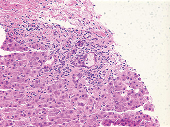 Fig. 1. Amoxicillin-clavulanic acid (Augmentin)-induced liver injury