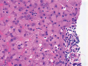 Ground glass cytoplasmic change in hepatocytes. “If I threw it out to the audience,” Dr. Najarian said of the above image, “everybody would say chronic hepatitis B, and it’s true, but it’s not a specific finding in chronic viral hepatitis. It has been associated with various drugs as well.”